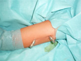 Operace cysty s aplikací ChronOs injectu Operace cysty s aplikací ChronOs injectu