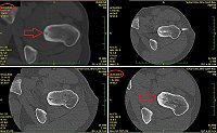 Obr. 6. RFA osteoidního osteomu levé kyčle a CT kontrola po roce